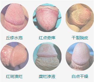 龟头炎