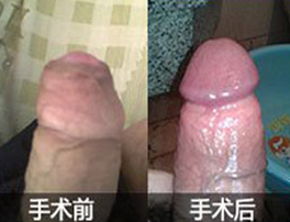 包皮