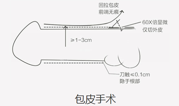 丽华微创包皮环切术