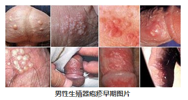 生殖器疱疹