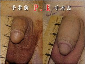 阴茎增粗