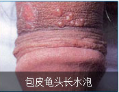 龟头炎